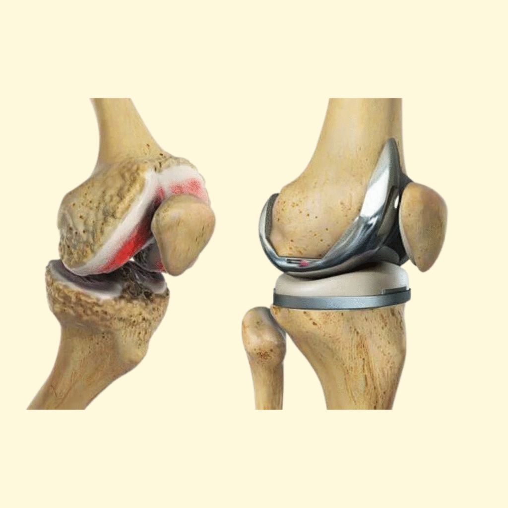 total knee replacement surgery